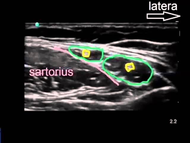 lateral femoral cutaneous nerve