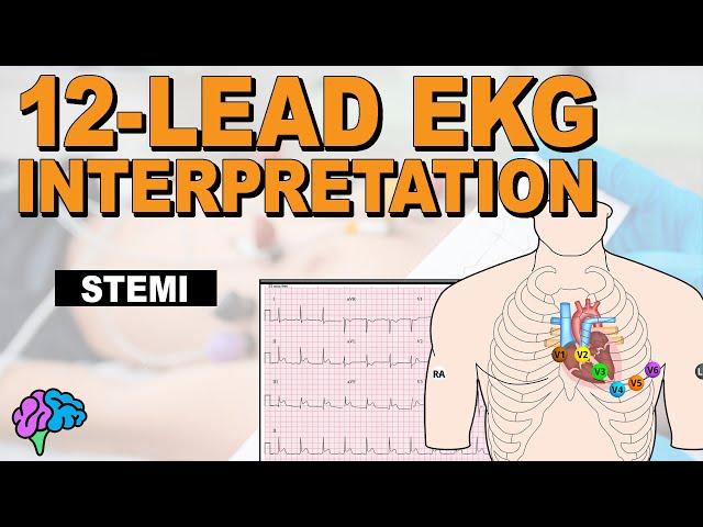 Recognize ST Elevation Myocardial Infarction (STEMI) on 12-lead EKG!