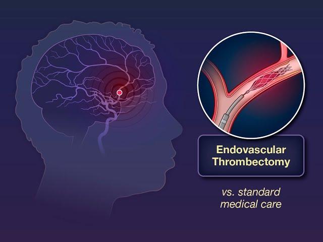 Endovascular Thrombectomy for Large Ischemic Strokes | NEJM