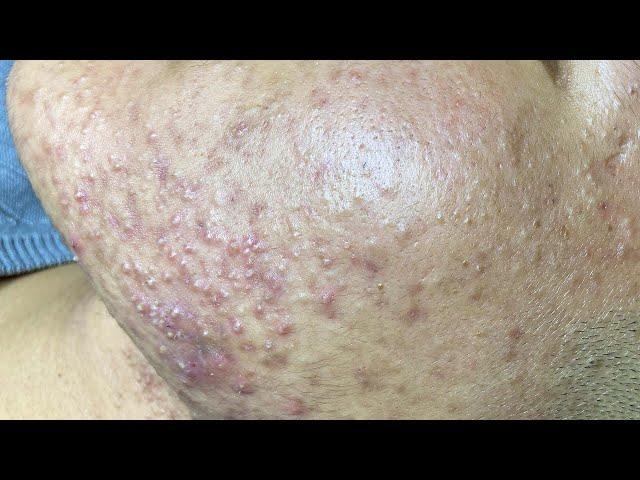 Acne Treatment For "Hung" (P5) | Điều Trị Mụn Cho Hùng (P5) =  SacDepSpa#192