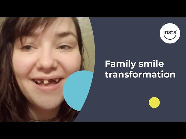Covering Missing Teeth | Clip On Veneers | Instasmile Review