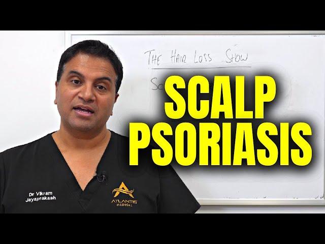 Scalp Psoriasis and Minoxidil