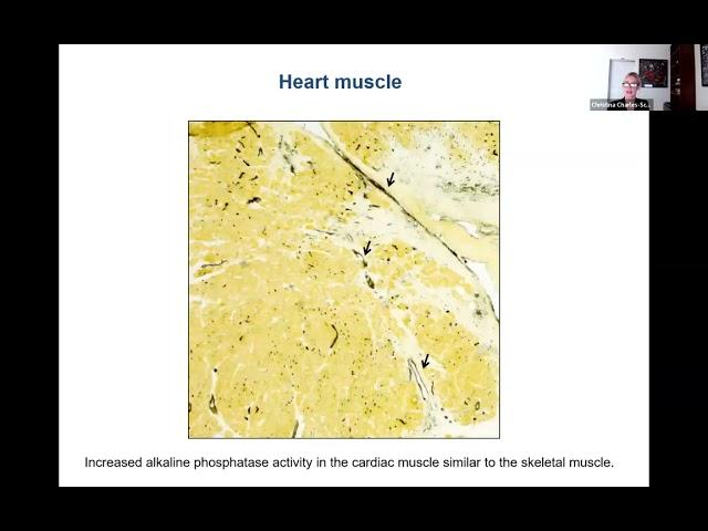 Myositis and Heart Disease with Dr. Christina Charles-Schoeman