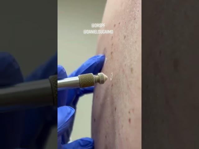 #shorts How Dermatologists Remove Skin Growths with Liquid Nitrogen