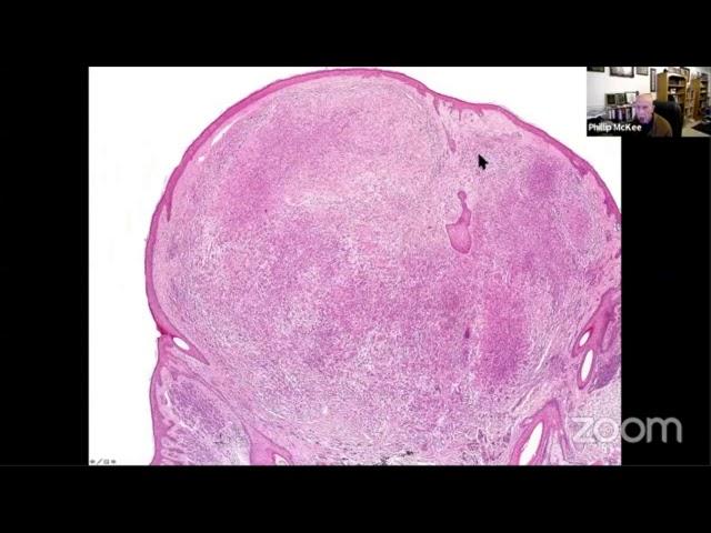 Edited BAPoma and kinase fusion Spitzoid tumors Phillip McKee