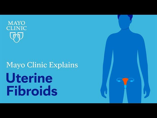 Mayo Clinic Explains Uterine Fibroids