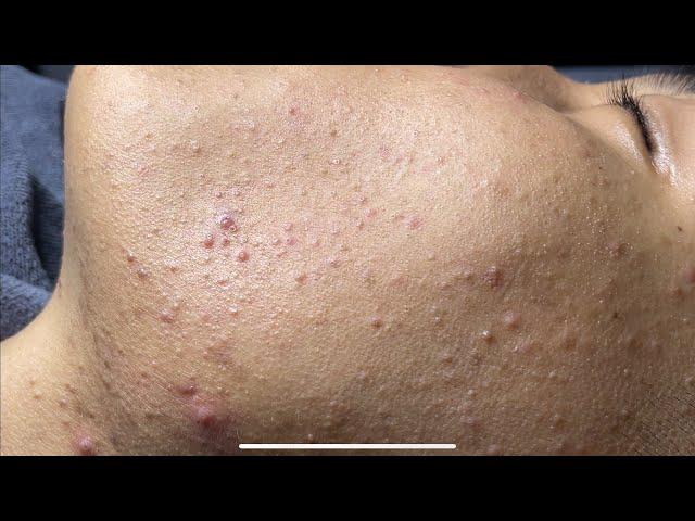 Blackheads & Whiteheads Removal New 2024 | Acne Treatment With  Bo Nguyễn Spa