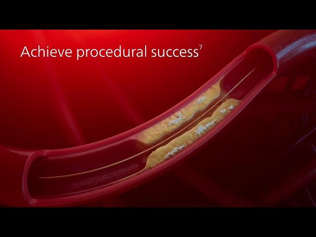 Philips Coronary Laser Atherectomy Catheter - ELCA  Mechanism of Action