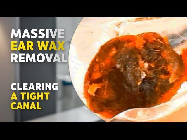 Clearing a Tight Ear Canal of Massive Ear Wax