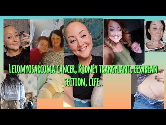 It's been tough, it's been beautiful! - Leiomyosarcoma terminal cancer & kidney transplant recipient