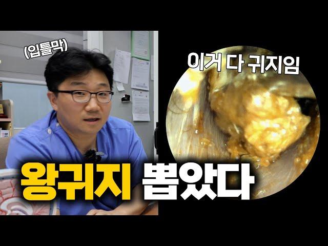 이비인후과 원장 피셜 '이만큼 큰 왕귀지 처음 빼봤다'