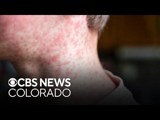 Colorado health officials confirm seventh measles case, on flight with others infected