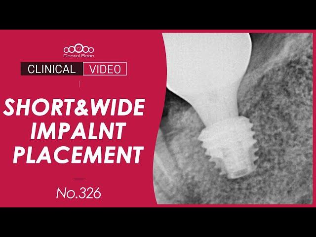 Short Implant Placement for Short Space with IAN [Dr. Kim Jaeyoon]