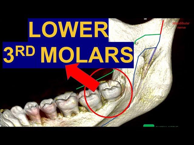 Secrets of Impacted Lower Third Molars: CBCT Surgical extraction of wisdom teeth removal surgery