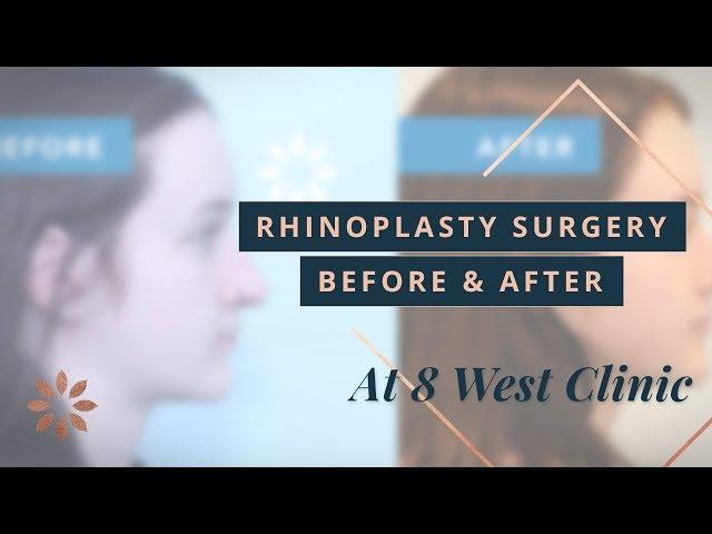 Rhinoplasty Transformations - Before & After Pictures | Dr. Buonassisi, 8 West Clinic in Vancouver