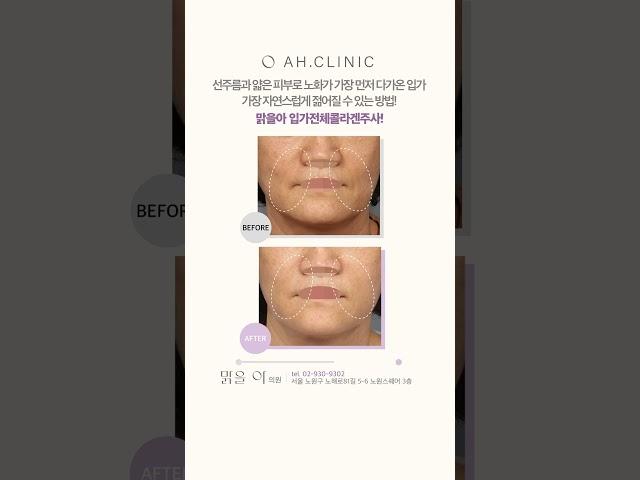 선주름과 얇은 피부로 노화가 가장 먼저 다가온 입가 가장 자연스럽게 젊어질 수 있는 방법! 맑을아 입가전체 콜라겐 주사!  #팔자주름 #입가주름 #팔자선주름 #자가진피재생술