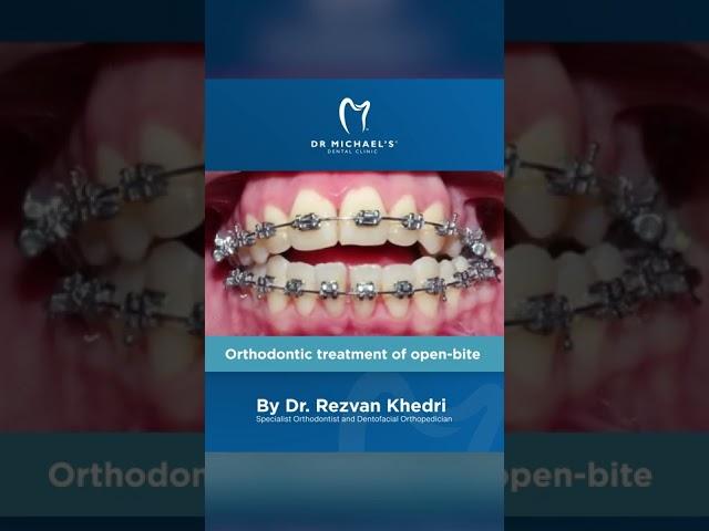 Orthodontic correction of open bite and cross bite by our Orthodontist Dr Rezvan