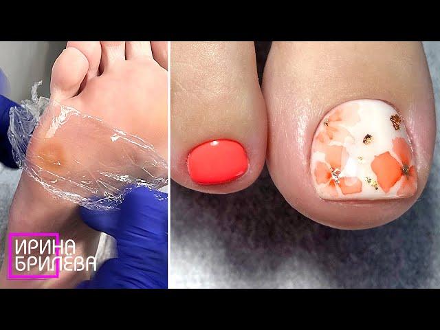 Pedicure Watercolor  Treatment of corns with maceration and keratolytic  Irina Brilyova