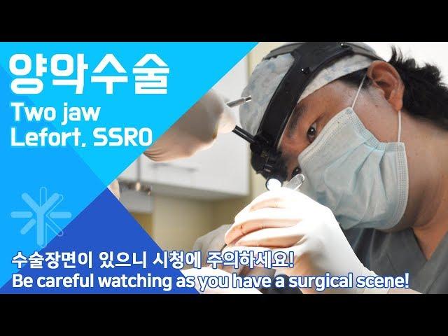 Two jaw, Lefort , SSRO, 양악수술