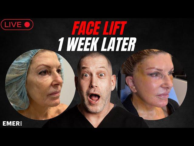 1 WEEK POST OP AFTER FULL FACIAL LIFTING SURGERY AND LASER COMBINATION | Dr. Jason Emer