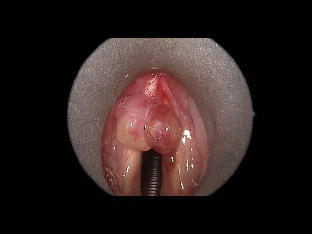 Large Vocal Cord Polyp Causing Hoarse Voice