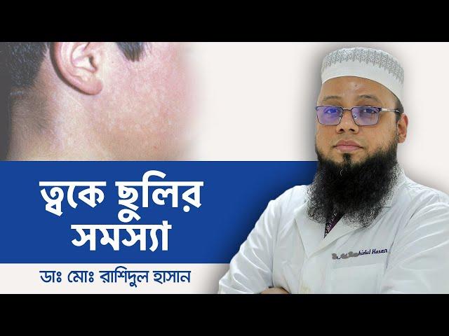 ত্বকের দাগ দূর করার উপায় | How To Remove Spots From Face | ত্বকের ছুলি দূর করার উপায়