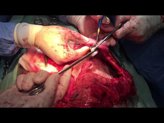 Megacolon, Total abdominal colectomy - performed by Sahib Huseynov M.D (Doctor of Medicine)