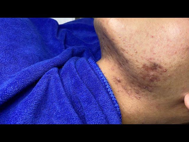 Acne Treatment For "Hung" (P18) | Điều Trị Mụn Cho Hùng (P18) - SacDepSpa#224