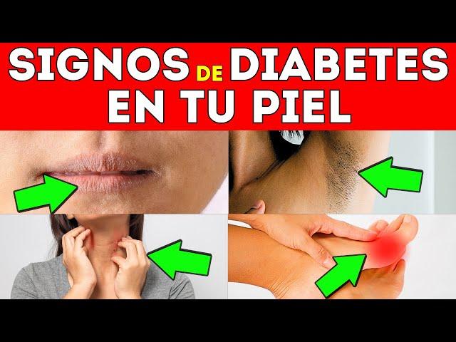 10 SEÑALES ALARMANTES de DIABETES en la PIEL