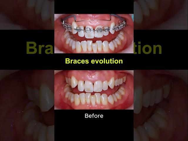 Braces evolution 2022-2025 #braces #dentist #orthodontist #teeth