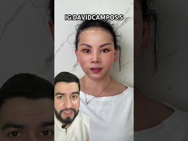 CAMBIO SU ROSTRO CON ESTÁ CIRUGÍA