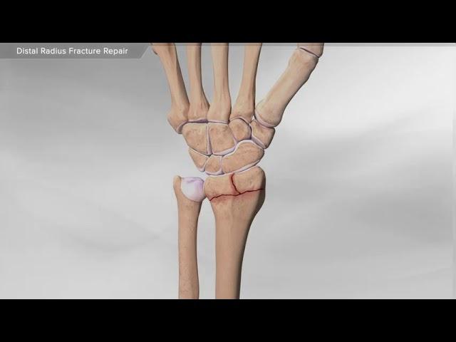 Distal Radius Fracture Repair (dorsal plating)