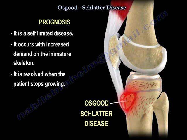 Osgood-Schlatter Disease