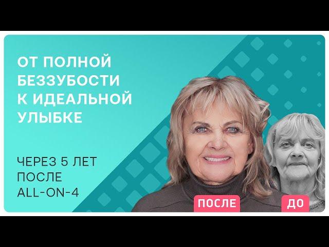 Как подготовиться к операции по установке имплантов? Рассказываю про свой опыт