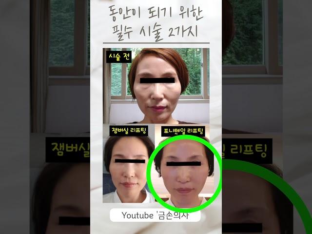 10년 이상 어려보이는 2가지 리프팅 시술