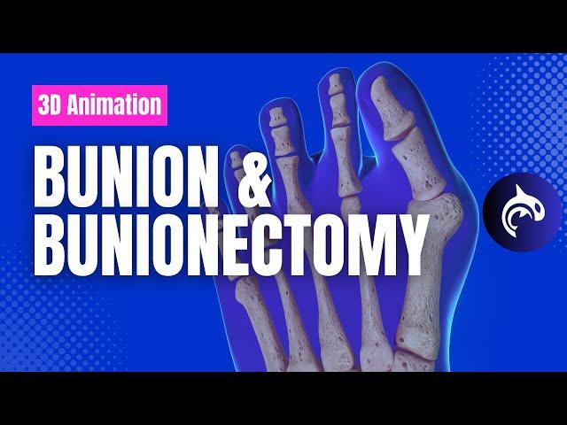 Bunion and Bunionectomy with Osteotomy - 3D Animation