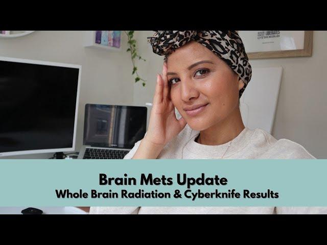 The Brain Mets Journey | Whole Brain Radiation and Cyberknife Results