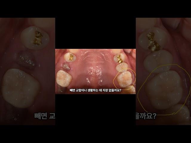 치아교정 계획 중 발치관련 재상담