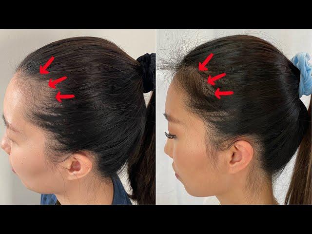 How I Fixed The Hairline? | iRestore Laser Hair Growth Therapy 4-Month Update | Chris Han