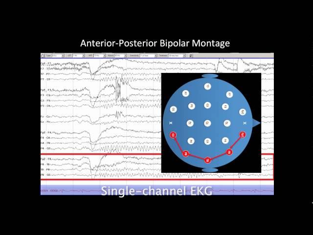 Introduction to EEG