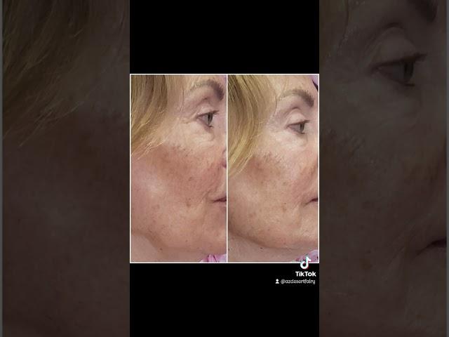 Arizona  Jet Plasma all natural face lift. Camp Verde Rimrock  #microneedle #fibroblast #plasmapen