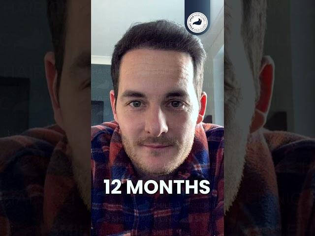 START YOUR TRANSFORMATION TODAY! - HAIR TRANSPLANT 12 MONTHS RESULT