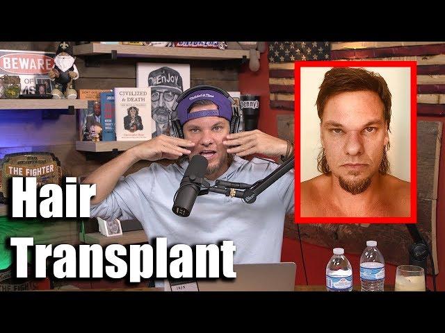 Theo Von talks FUE hair transplant procedure