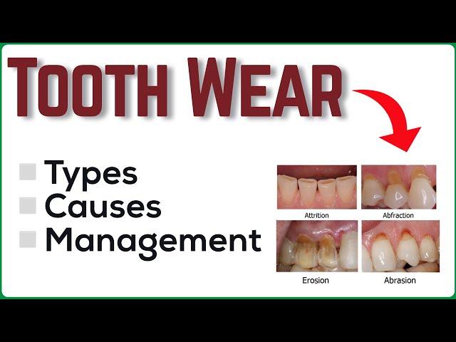 TOOTH WEAR - Types, Causes & Management