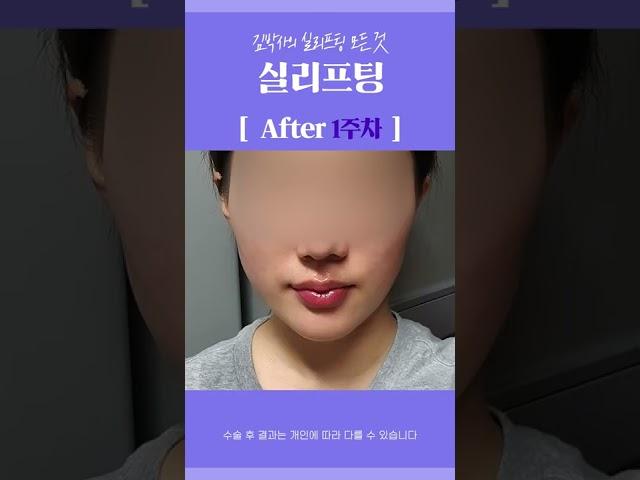#shorts 실리프팅 효과 살펴보기! 피부 처짐 문제는 이것으로 해결!