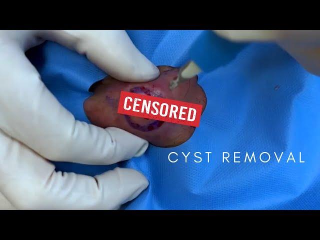 Dr. Timothy Jochen Handles A STUBBORN Cyst | CONTOUR DERMATOLOGY