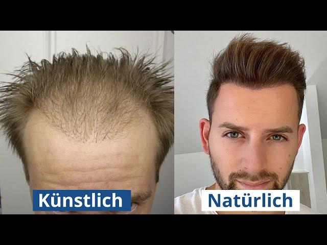 Haartransplantation: künstliche vs natürliche Haarlinie?! Woran erkennt man es?