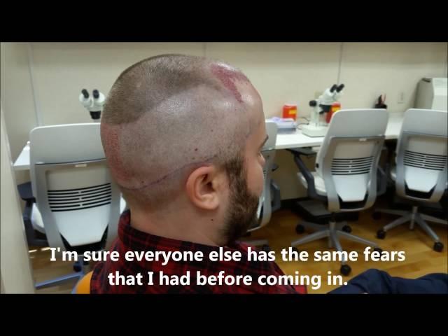 Patient IMMEDIATELY following an ARTAS robotic hair transplant talks about what it was like!