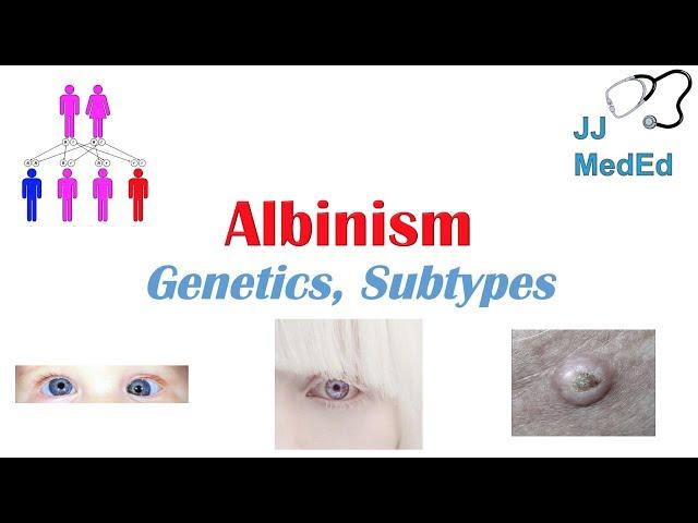 Albinism | Genetics, Different Types, and What You Need to Know