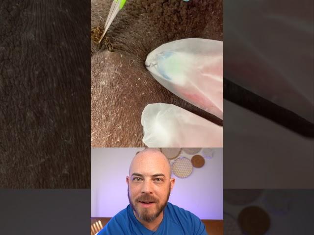 Derm reacts to INSANE ingrown hair extraction! #dermreacts #doctorreacts #ingrownhair